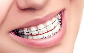 ortodoncia estética